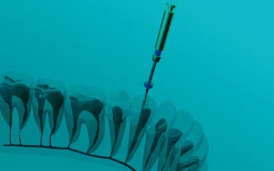 Jak przebiega leczenie kanałowe?